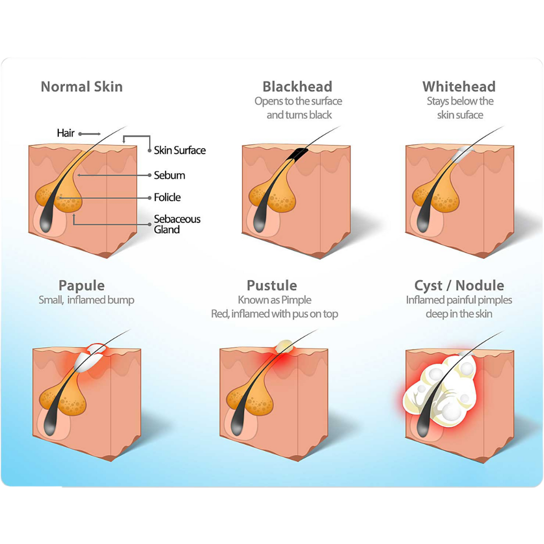 Acne/Rosacea Amino Acid