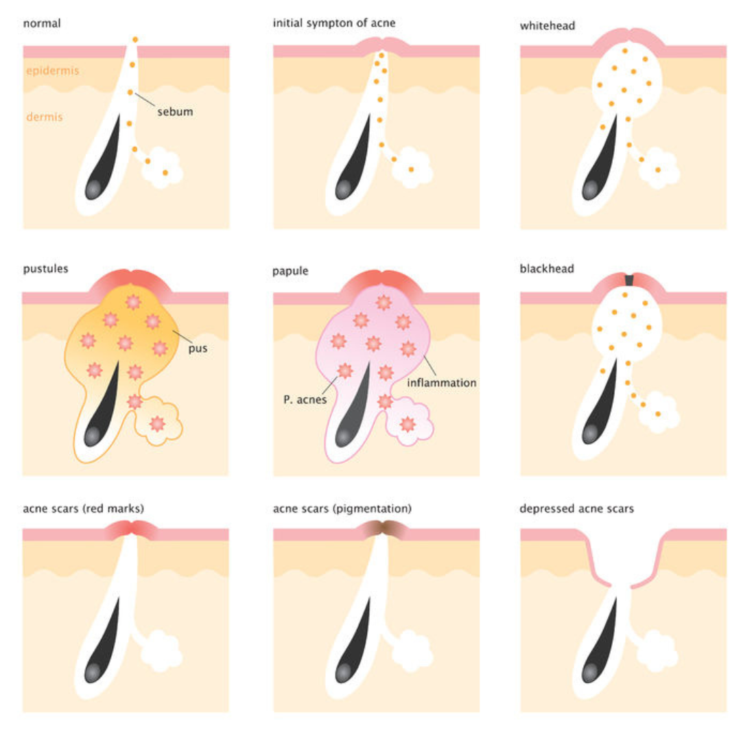 Acne/Rosacea Amino Acid